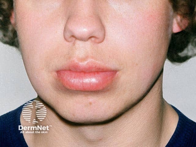 Lower lip swelling due to granulomatous cheilitis