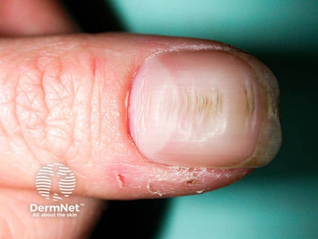 Transverse nail ridges with partial cuticle loss and bolstering of the nail fold due to repetitive pushing back of the nail fold by the adjacent index finger