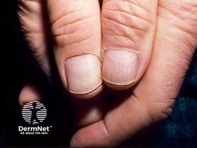 Permanent nail dystrophy following cessation of trauma