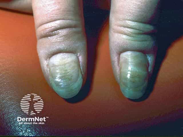 Rippling of the central part of the nail plate and loss of the cuticle in habit-tic nail