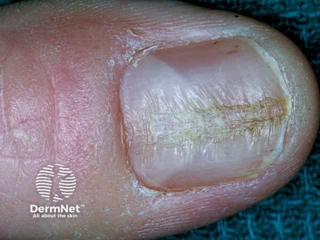 Rippling of the central part of the thumbnail plate and loss of the cuticle in habit-tic nail