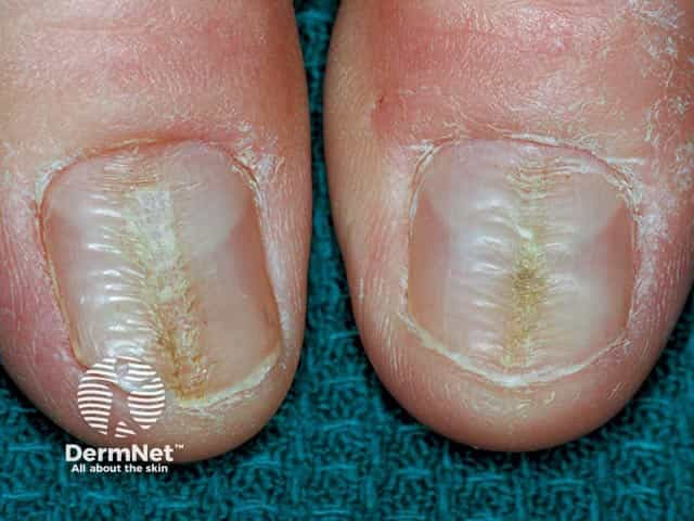 Rippling of the central part of the thumbnail plate and loss of the cuticle in habit-tic nail