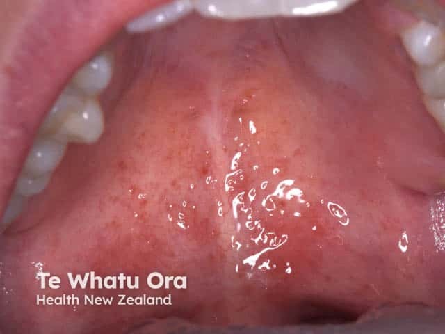 Pre-vesicular erythematous lesions on the palate in hand, foot and mouth disease