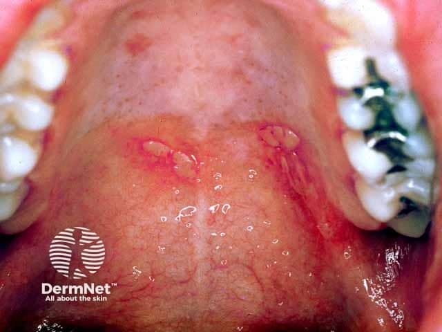 Palatal vesicles in hand, foot and mouth disease