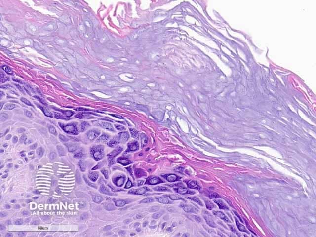 Hypergranulotic dyscornification: histology high power