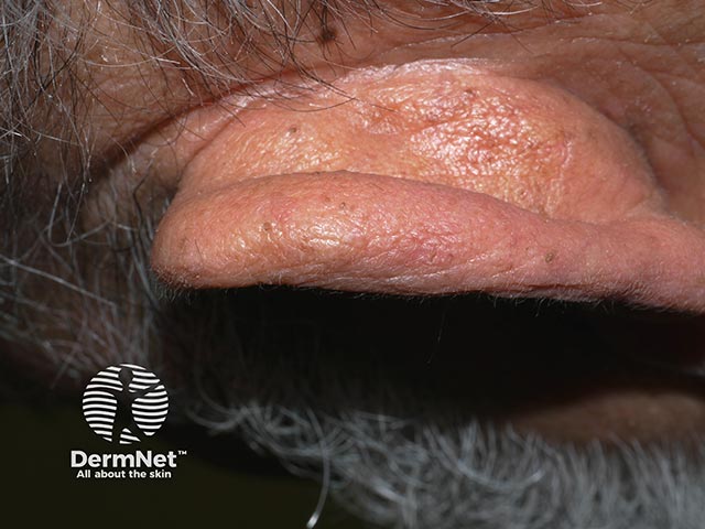 Scaly papules on the ears, typical of Flegel's disease