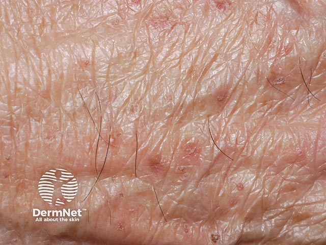 Close-up of Flegel's disease - lesions on the hand