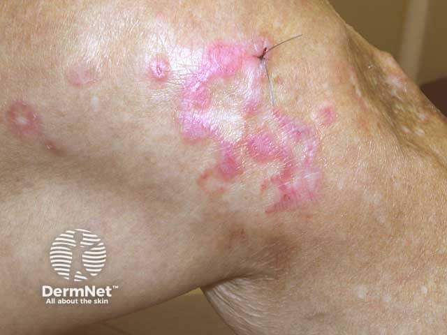 Hypertrophic lichen planus on the knee