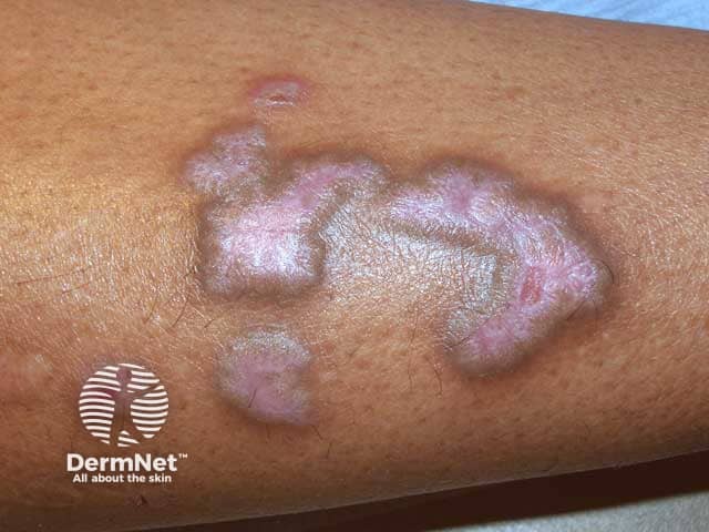 Raised excoriated purple shin plaques due to hypertrophic lichen planus