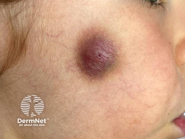 Violaceous plaque on the cheek due to idiopathic facial aseptic granuloma