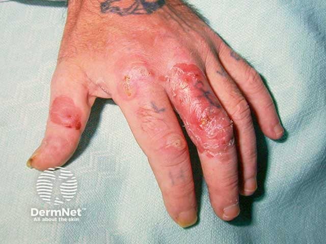 Impetigo in HIV infection 