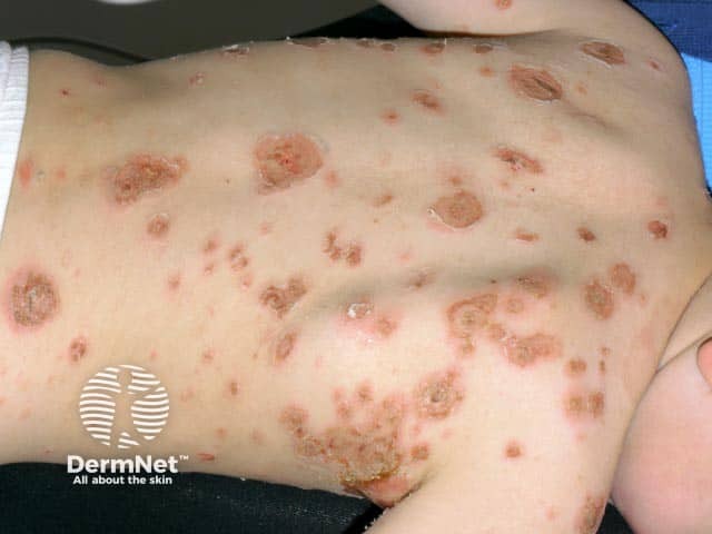 Widespread bullous impetigo over the back