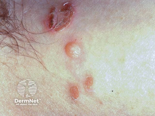 An intact blister and erosions in bullous impetigo