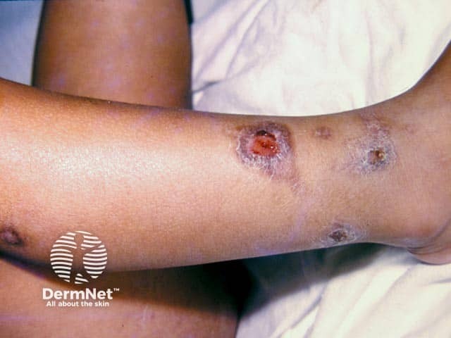 Impetigo on the leg