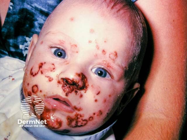 Crusted weepy lesions in facial impetigo