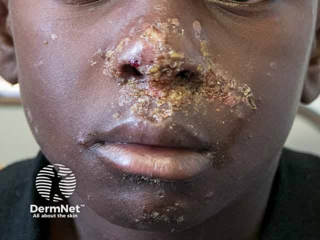 Honey-coloured crusted lesions in facial impetigo