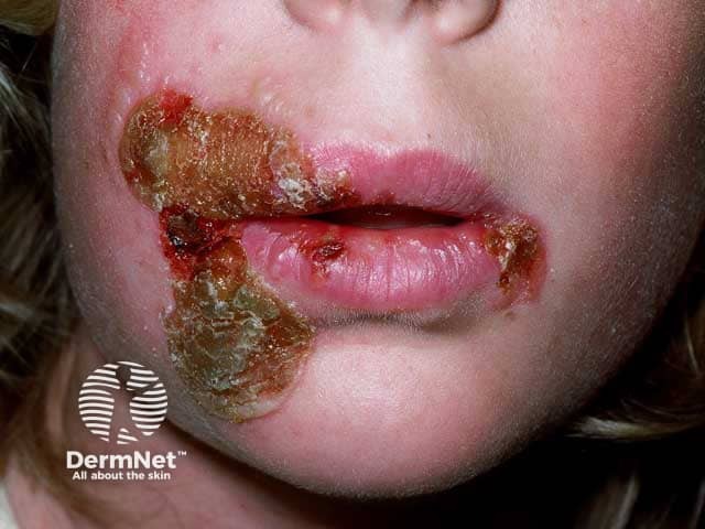 Perioral honey-coloured crusts in impetigo