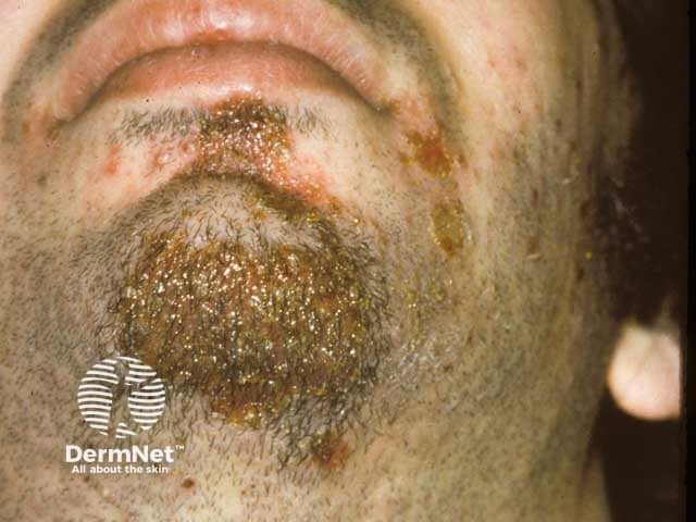 Honey-coloured crusts on the chin in impetigo