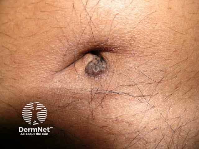 A periumbilical keloid after laparoscopy