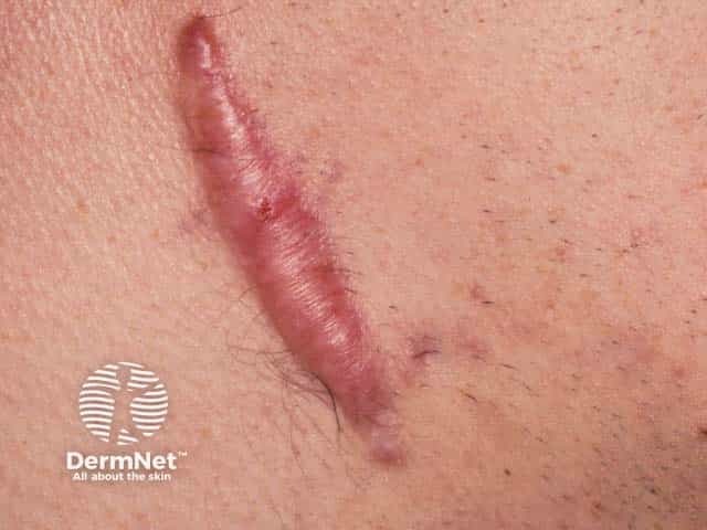 A thickened firm and tender post-surgical keloid scar