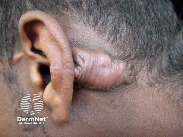 A retroauricular keloid