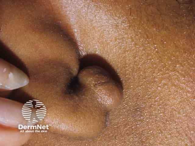 Keloidal reaction to ear piercing