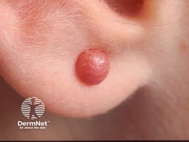 A keloid on the earlobe after piercing