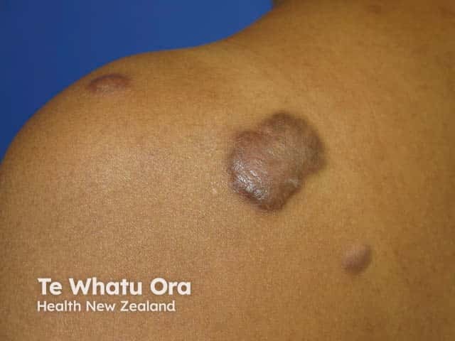 A large keloid on the back