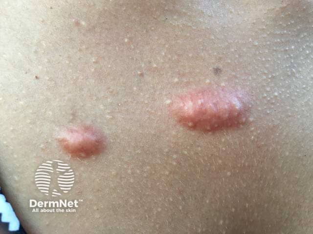 Post-acne keloid scars