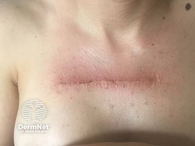 Ten days post surgical excision and radiotherapy to a keloid scar