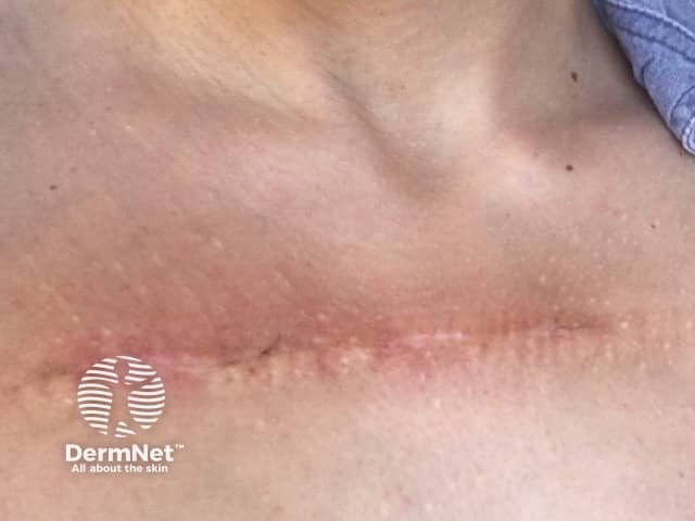 Two weeks post excision and radiotherpy to a chest keloid