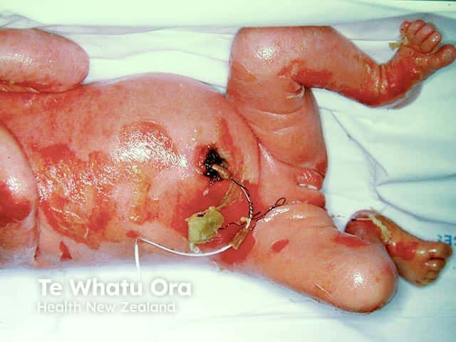 Denuded areas of skin on the abdomen and legs with erythroderma in a neonate with bullous ichthyosiform erythroderma