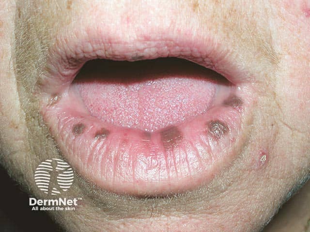 Labial pigmented macules in Laugier-Hunziker syndrome