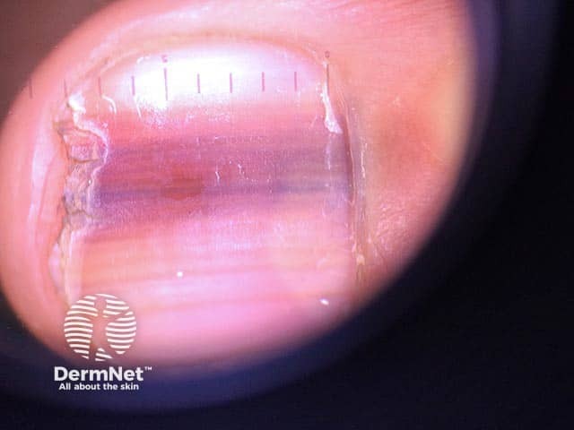 Longitudinal fingernail melanonychia in Laugier-Hunziker syndrome