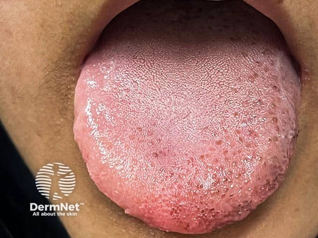 Pigmented macules on the tongue in Laugier-Hunziker syndrome - there may be similar pigmentation on the lips and palate