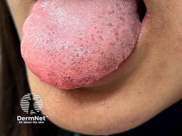 Pigmented macules on the tongue in Laugier-Hunziker syndrome - there may be similar pigmentation on the lips and palate