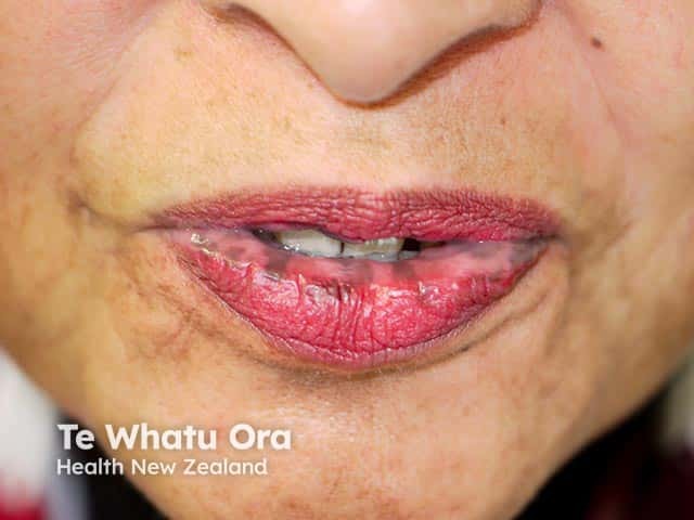 Pigmented macules on the lower lip in Laugier-Hunziker syndrome