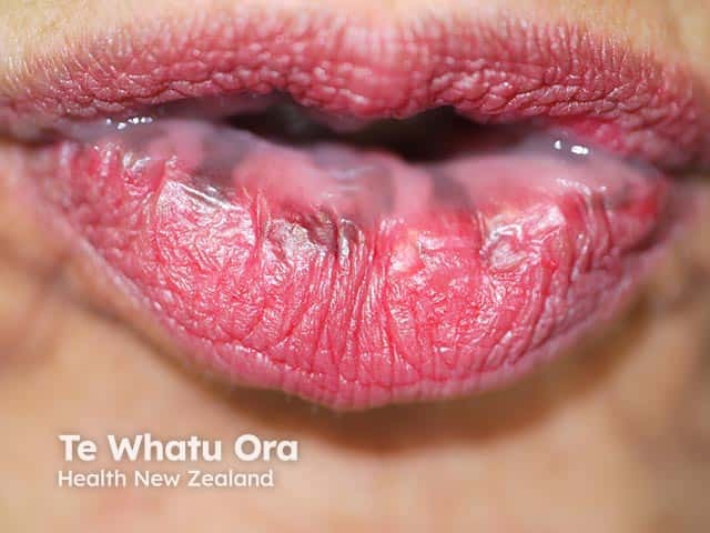 Pigmented macules on the lower lip in Laugier-Hunziker syndrome