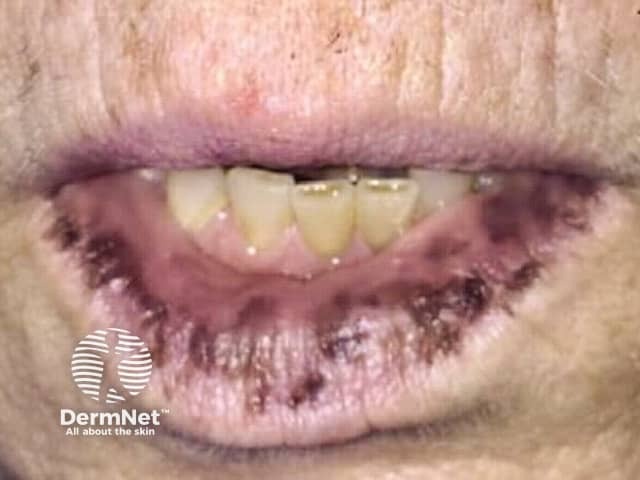 Labial pigmented macules in Laugier-Hunziker syndrome