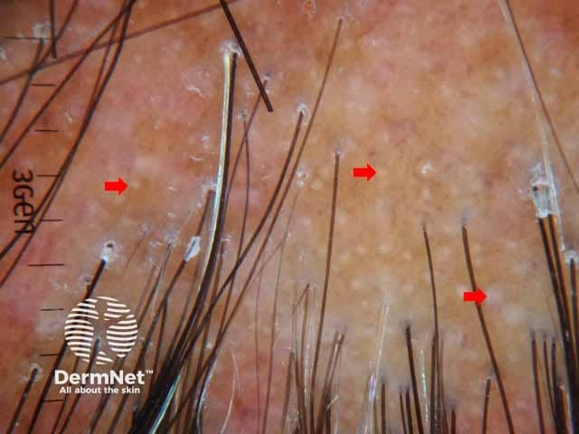 Dermoscopic image of lichen planopilaris presenting with irregularly distributed follicular openings (red arrows) denoting scarring (cicatricial) alopecia