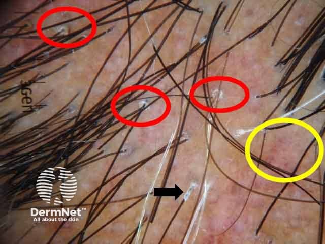 Dermoscopic image showing perifollicular scales (red circles, peritubular cast (black arrows) and blue grey dots (yellow circles)