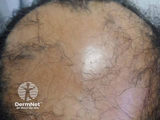 The atrophic scalp of a male patient with Graham-Little syndrome