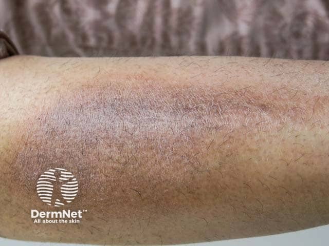 Hyperpigmentation and lichenification in lichen simplex on the arm