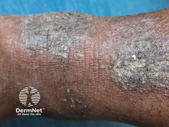 Hyperpigmentation and hyperkeratosis due to lichen simplex on the arm