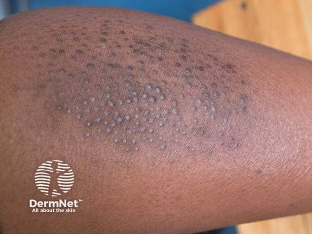 Papular lesions within an area of lichen simplex on the shin