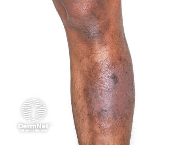 Lichen simplex resulting in lichenification and hyperpigmentation on the shin