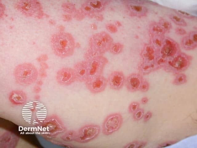 String of pearls sign in linear IgA disease