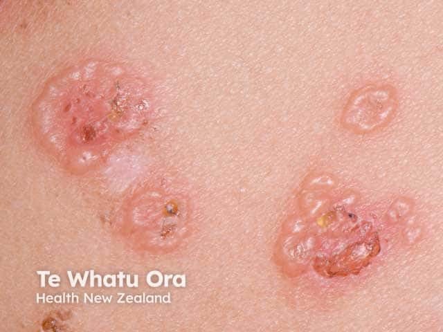 String of pearls blisters in linear IgA disease