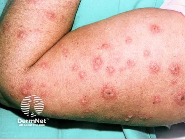 String of pearls blisters in linar IgA disease