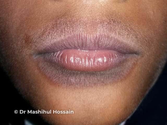 Lip licker's dermatitis